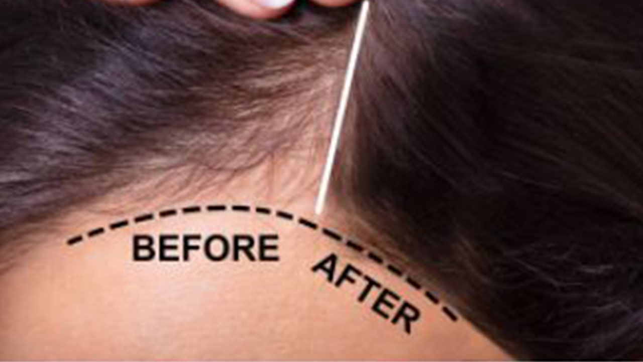 Does onion juice work perfectly?