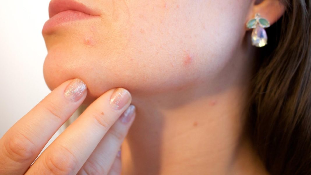 How To Get Rid Of Blackheads - Here Are 12 Ways