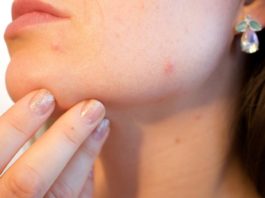 How To Get Rid Of Blackheads - Here Are 12 Ways