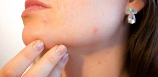 How To Get Rid Of Blackheads - Here Are 12 Ways