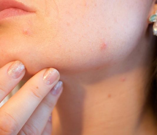 How To Get Rid Of Blackheads - Here Are 12 Ways