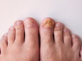 Fungal Nail Infection: Overview, Causes and Treatment Fungal Nail Infection: Overview, Causes and Treatment