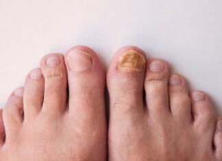 Fungal Nail Infection: Overview, Causes and Treatment