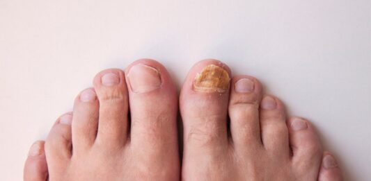 Fungal Nail Infection: Overview, Causes and Treatment