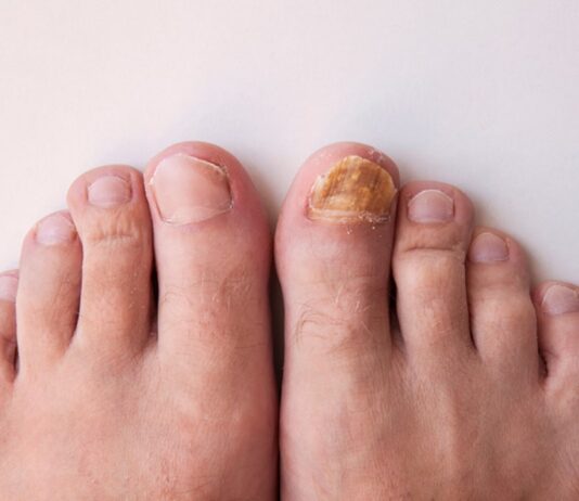 Fungal Nail Infection: Overview, Causes and Treatment
