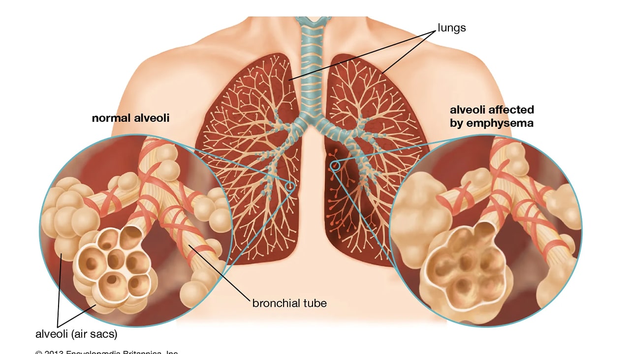 Respiratory problems